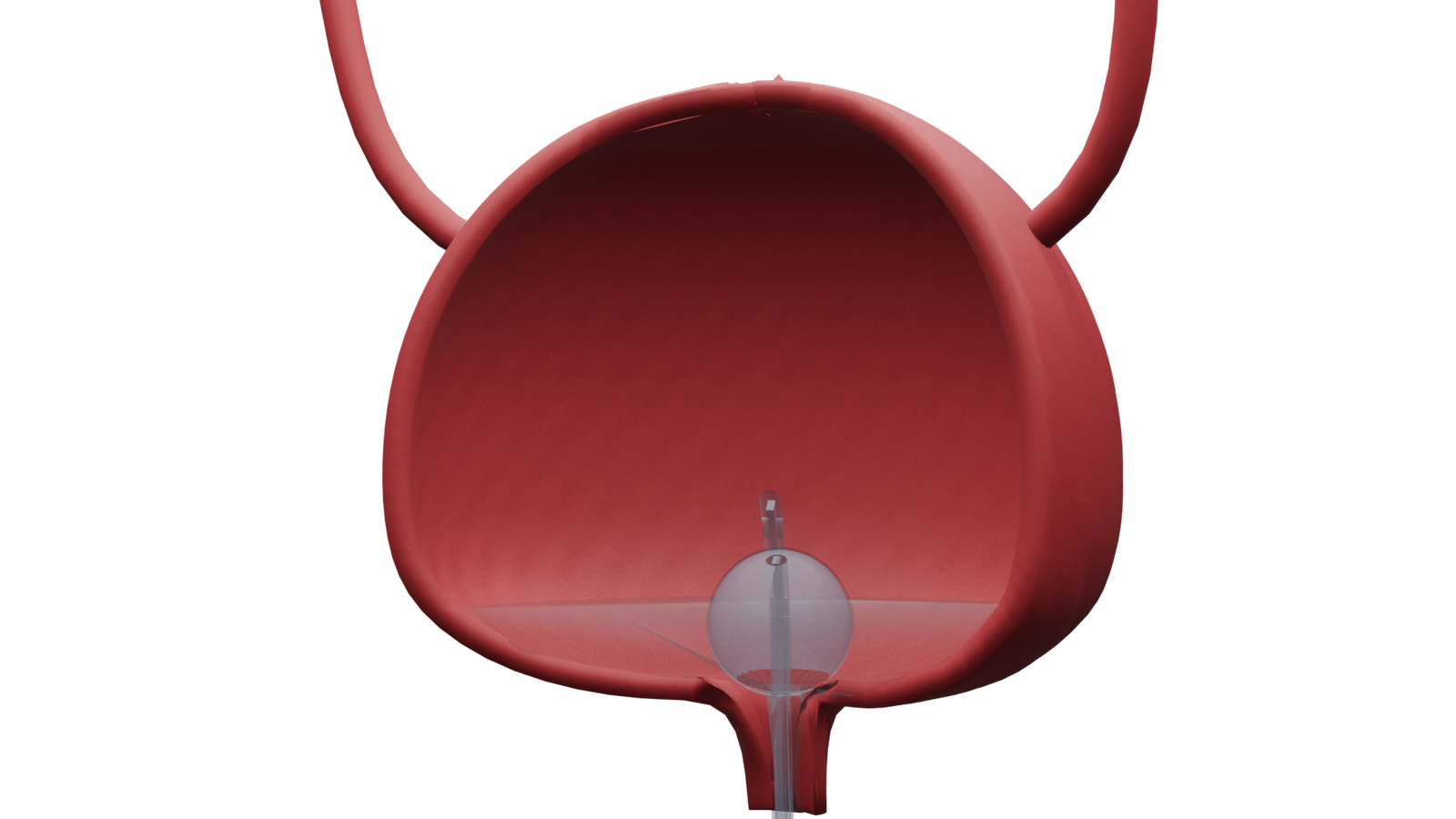 Foley Catheter's Elevated Drainage Port